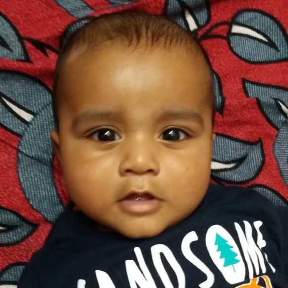 Hi Doctor My 5 Month Old Baby Boy Having White Patch Above His