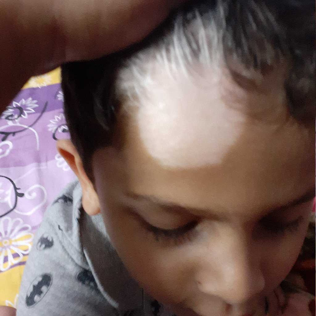 Hello Dr My Boy Got White Patch On His Forehead How Much Time It