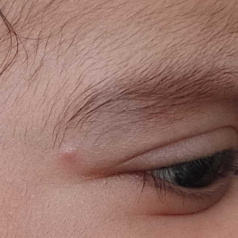 my baby has strawberry nevus near his eyebrow..when will it get cured