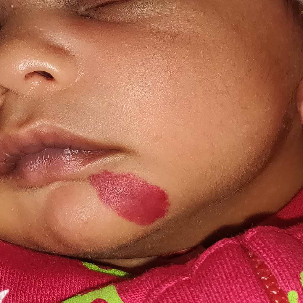 My Baby Is 15 Days Old He Has Some Red Patch On His Chin Is