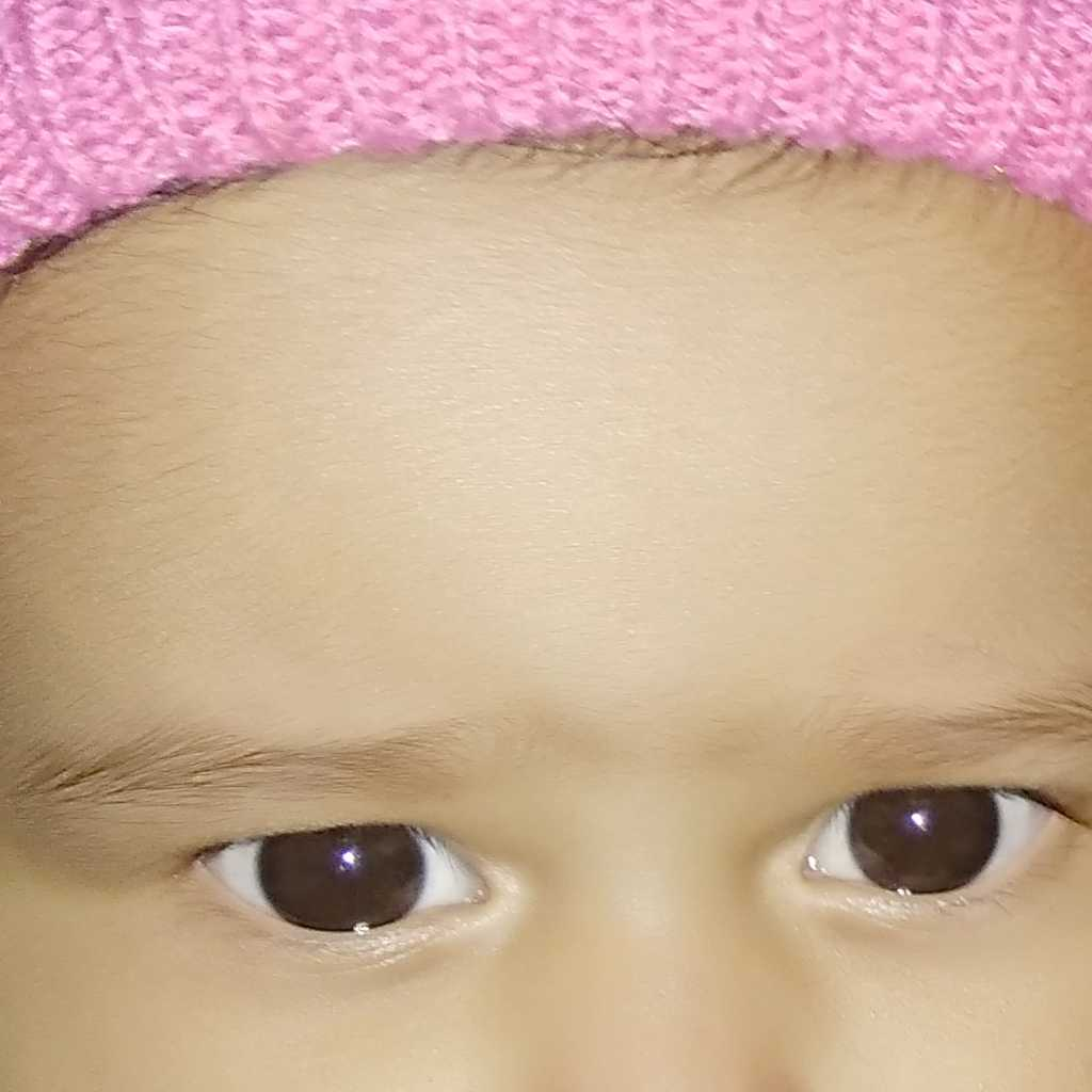 My baby has white patch around the corner of the left eye and in the