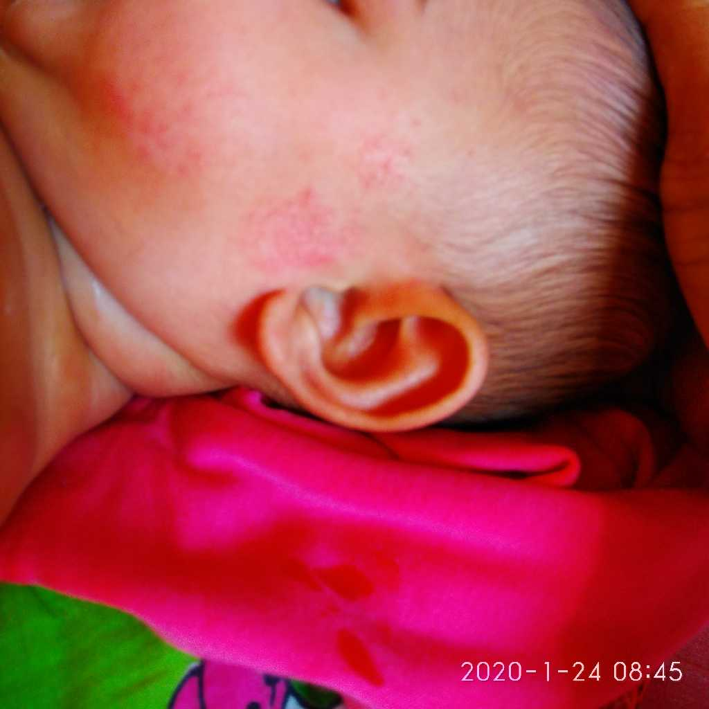 AskTheExperts My baby face is having light red marks on the chin and