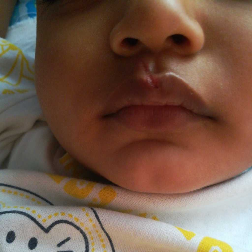 Both corners of my upper lips got burned because of wax strips.. Burn