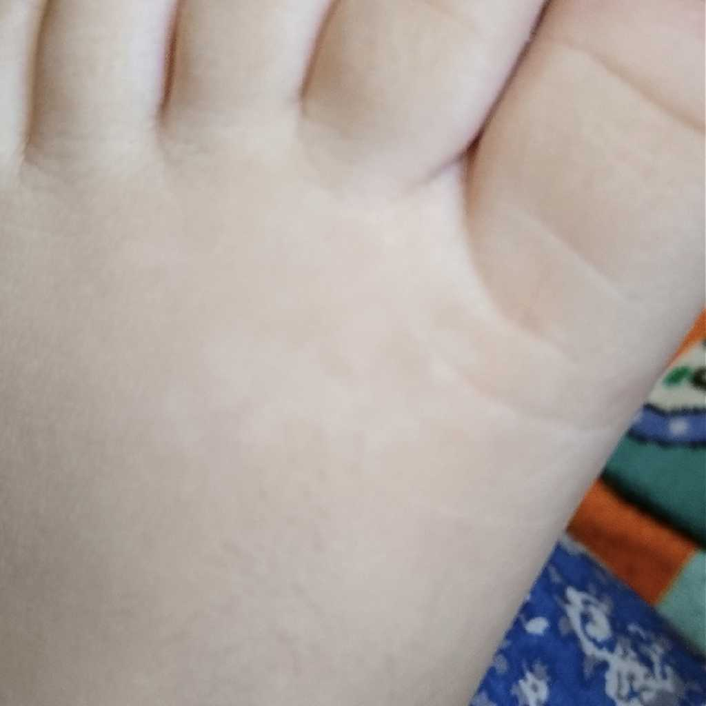 AskTheExpert white patches on baby’s foot FirstCry Parenting
