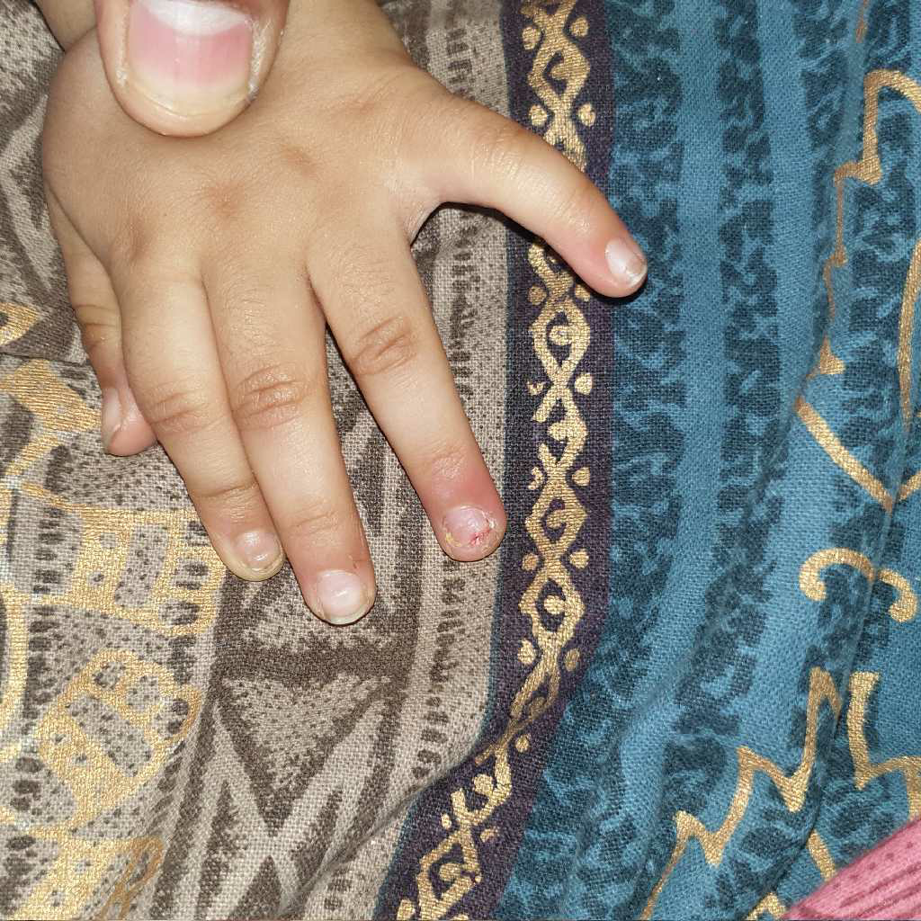 2 months old my baby got hurt accidentally with a nail by her elder