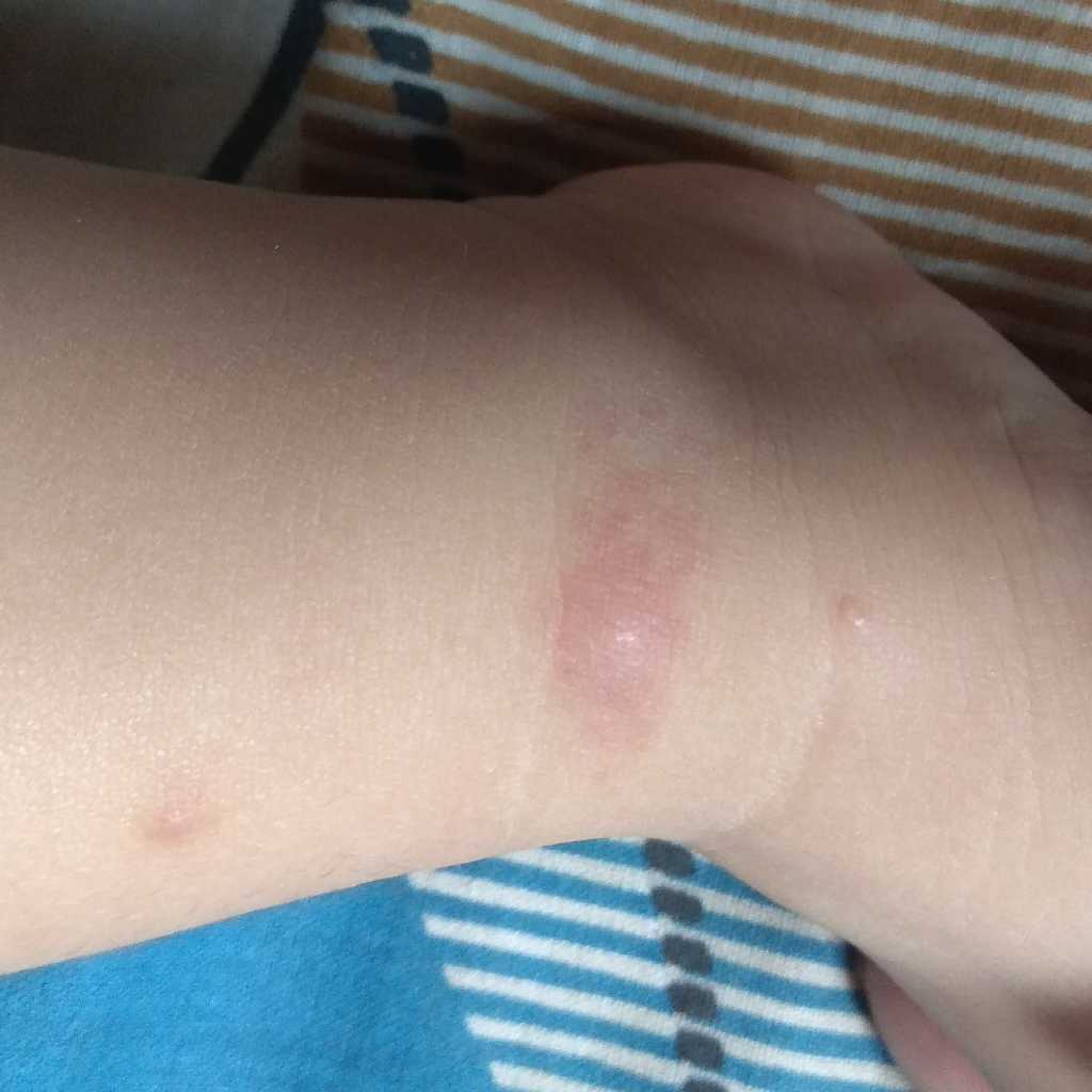 my baby is 25 days old, having red spots on his legs and face, see photo FirstCry Parenting