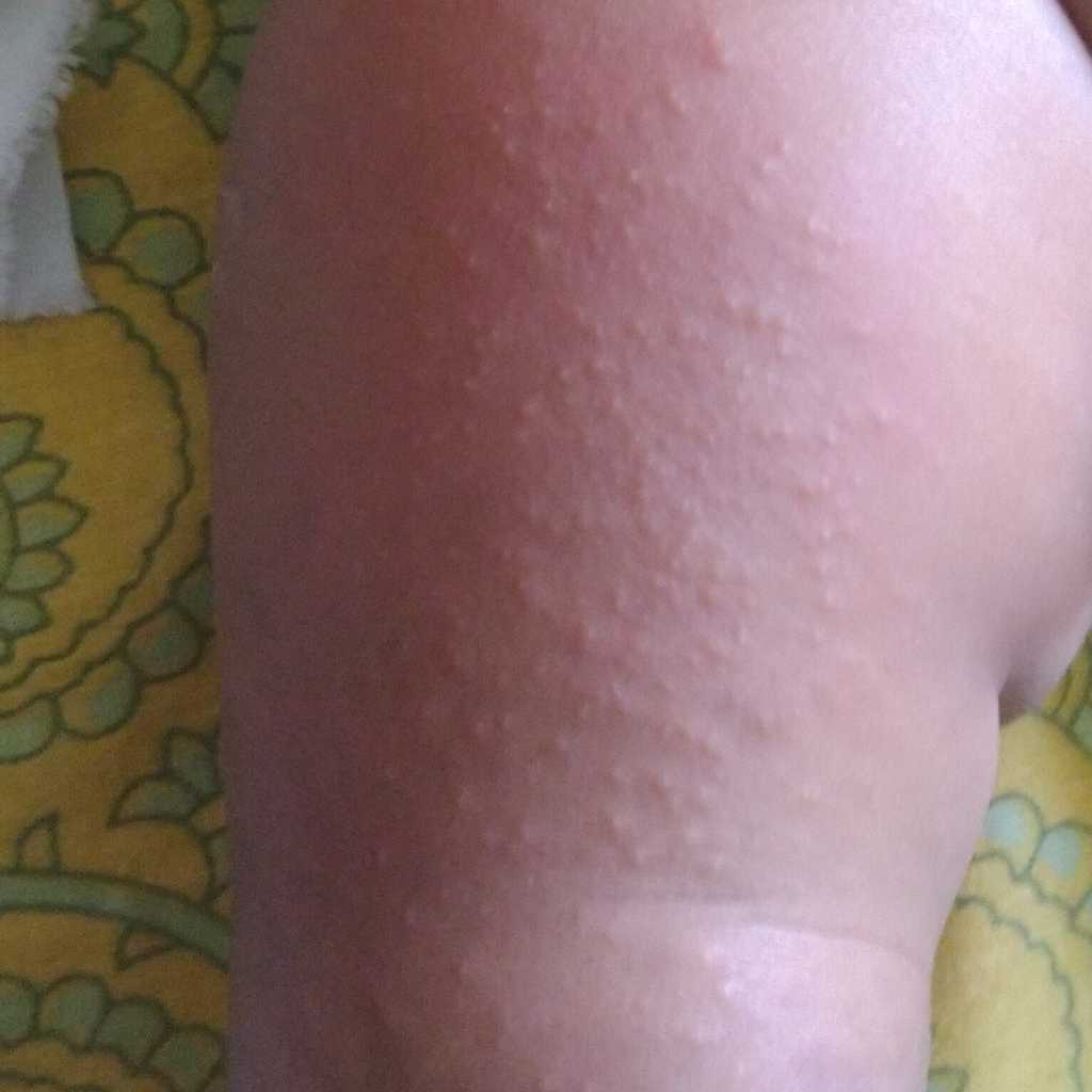 hi my 8 month baby has developed rashes on his right thigh this morning