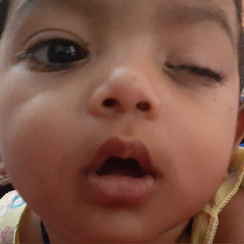 my baby is 5months old.. n since last 5 days his left eye gets swelling