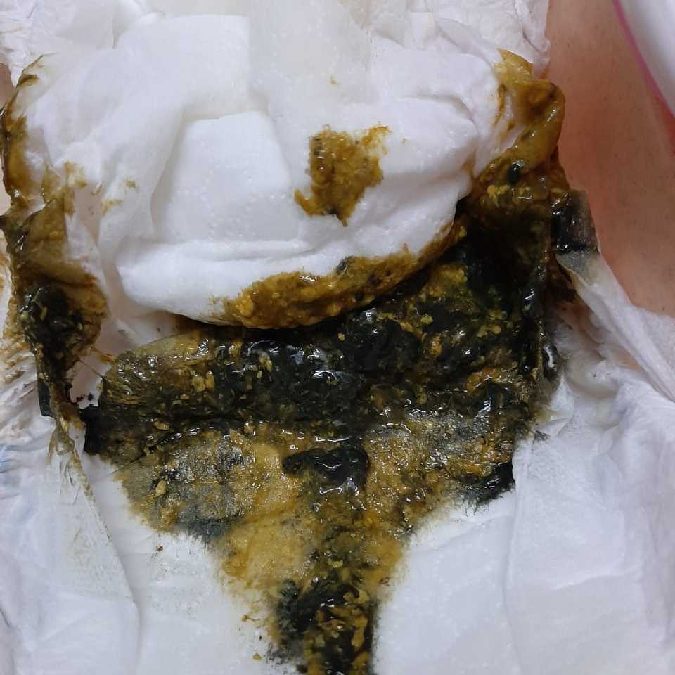 Hi.. my baby is 5 + months old and he is diagnosed with CMPA and probability of lactose