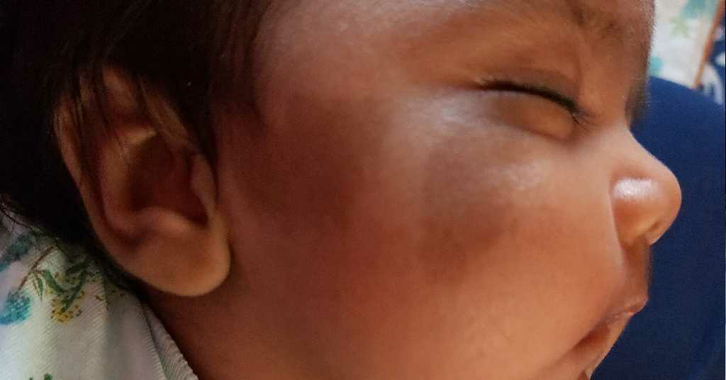 my daughter is having black marks on her face she is now 1. 5 month old