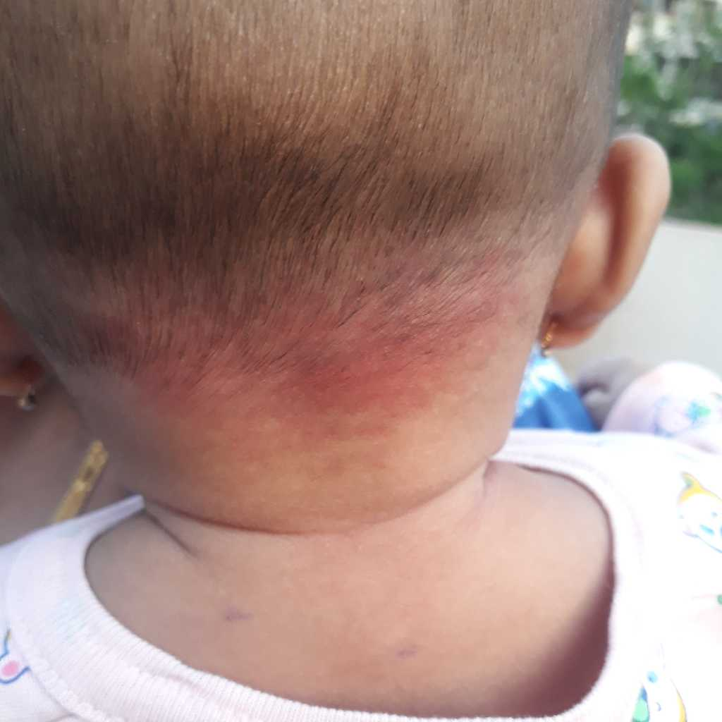 summercare Our baby boy is 4 months old. his skin on head, behind ears