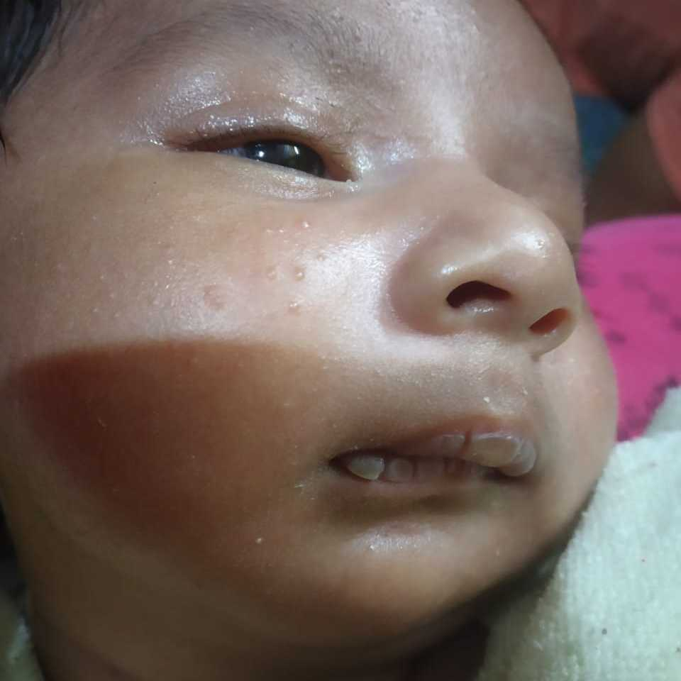 Hi please find attached picture of my baby face ,she had bubble pimple