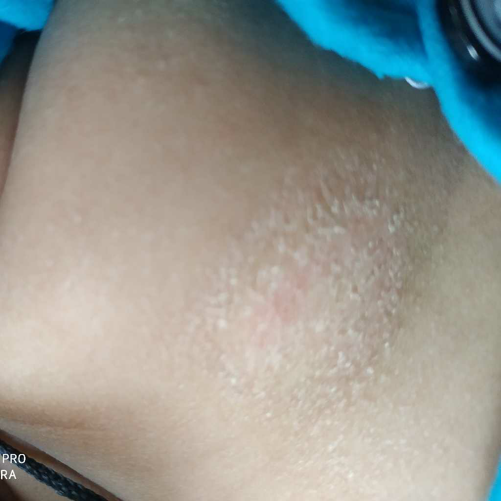 My child has a rashes like spotted in her chest? What it means