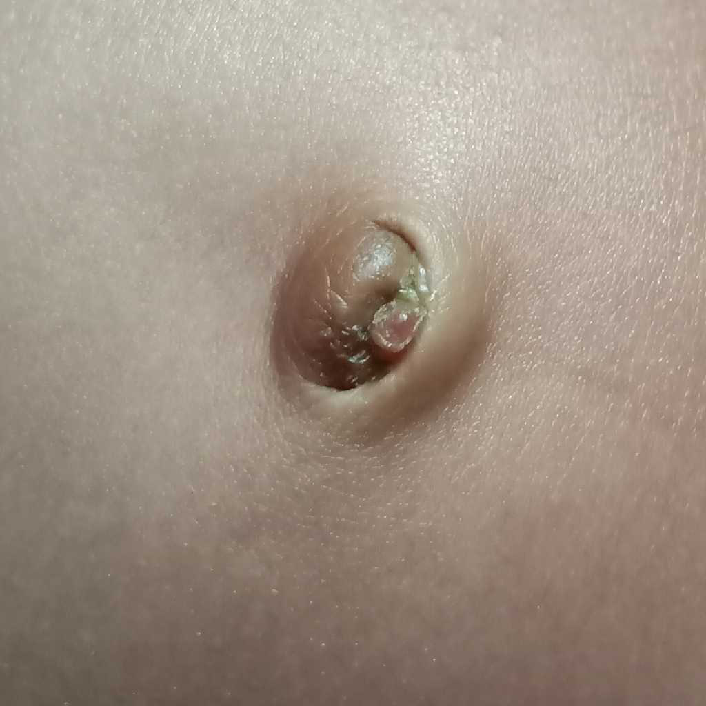 Granuloma En El Piercing Del Ombligo My son is 1 month baby. Still his navel shows like as in the attached pic.  Is it shows because any infection Or will it take more time to set normal?  Please