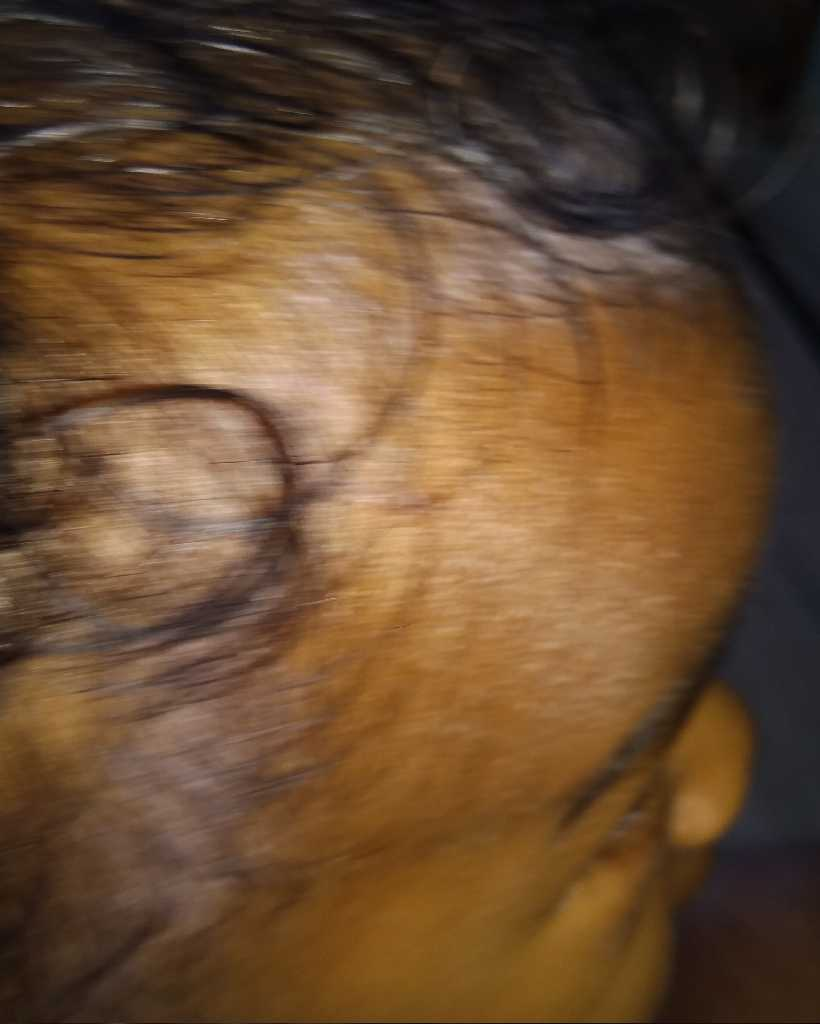 sebamed prickly heat powder