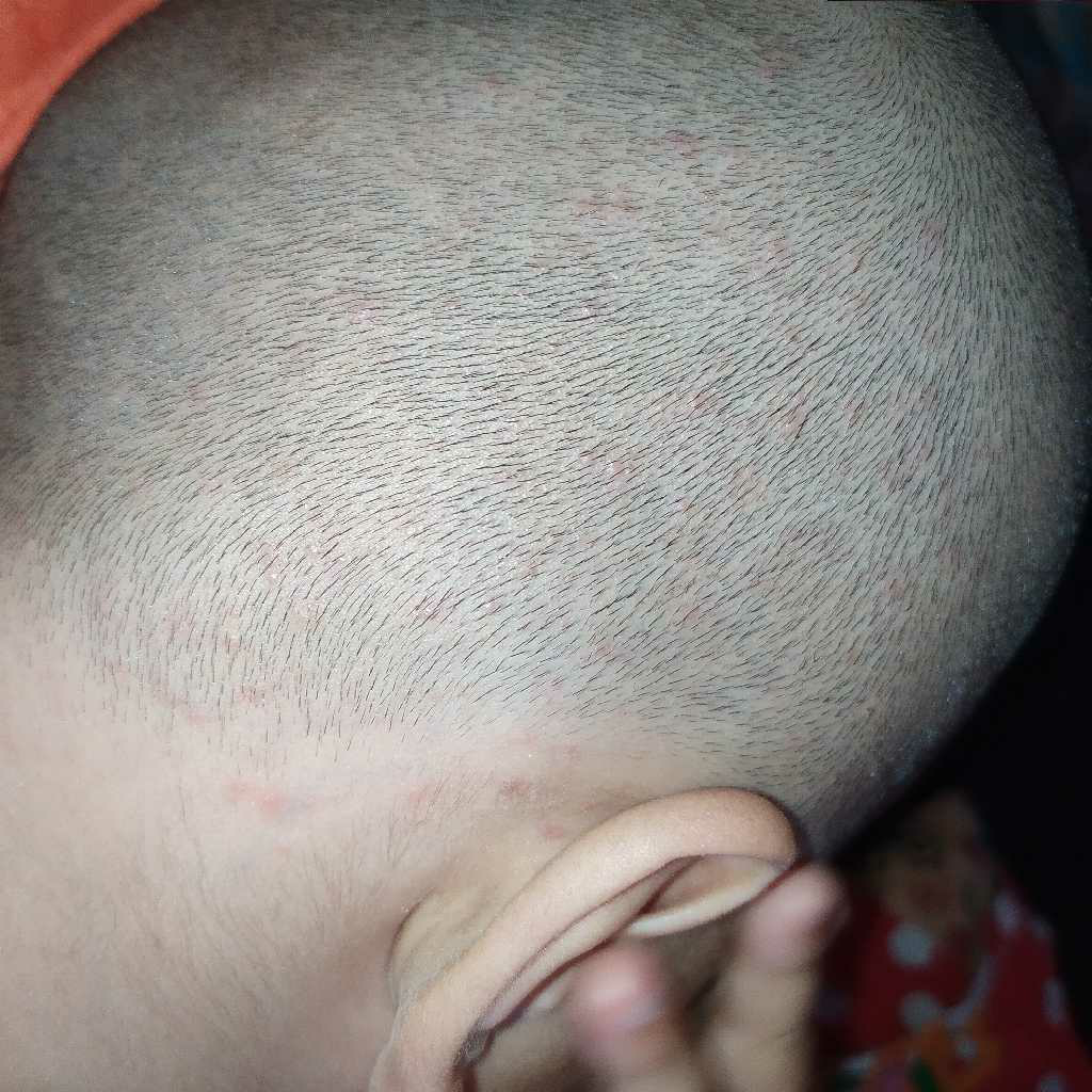List 91+ Images Rash On Back Of Head After Haircut Latest