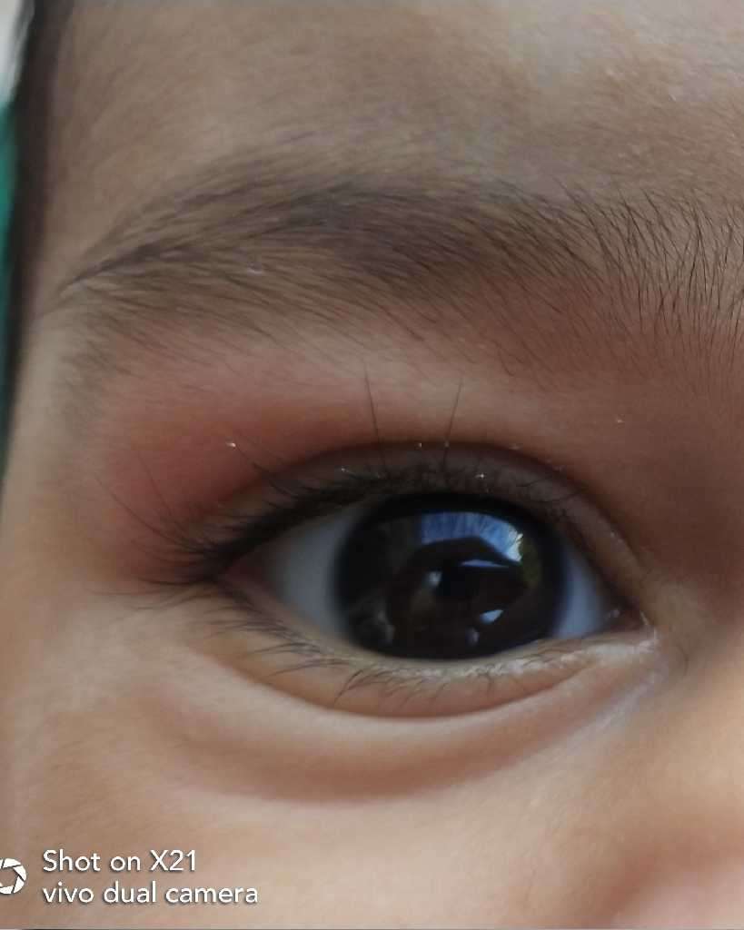 my baby have redness on eyes and eyebrows....what should I do