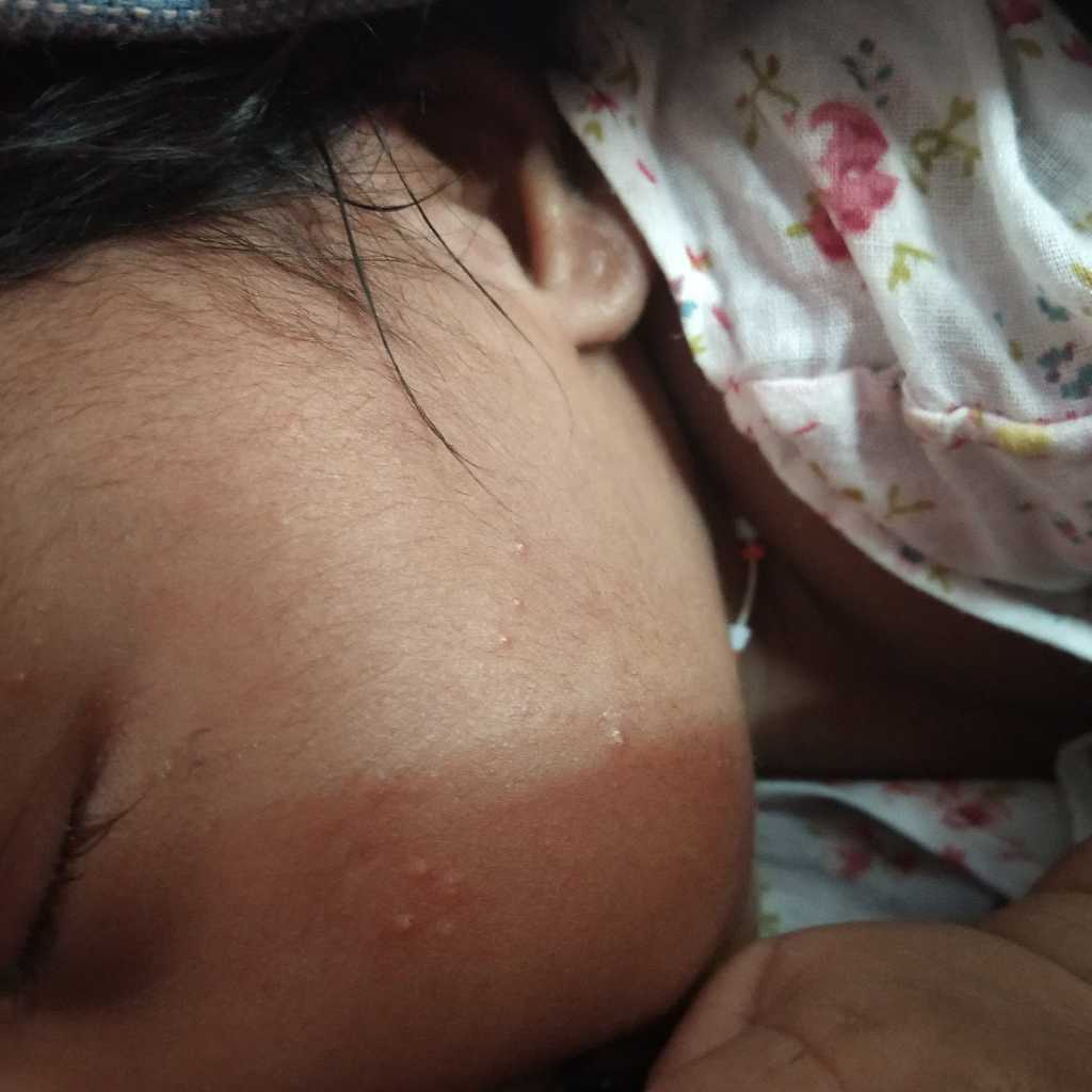 My baby has got pimple on his nose I have attached the picture ...