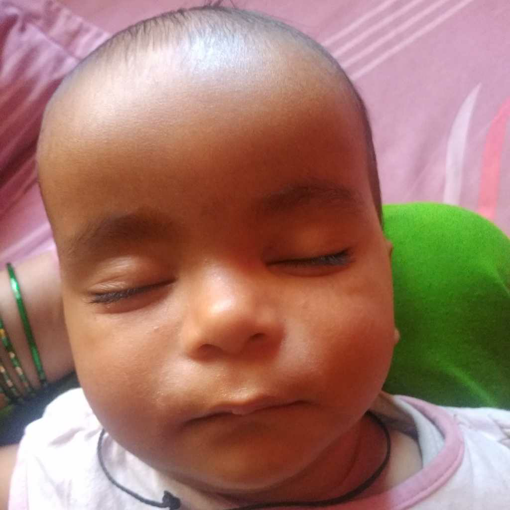 My Daughter Is 10 Months Old And Has Light White Spot Near Nose And My Daughter Is 10 Months Old And Has Light White Spot Near Nose And