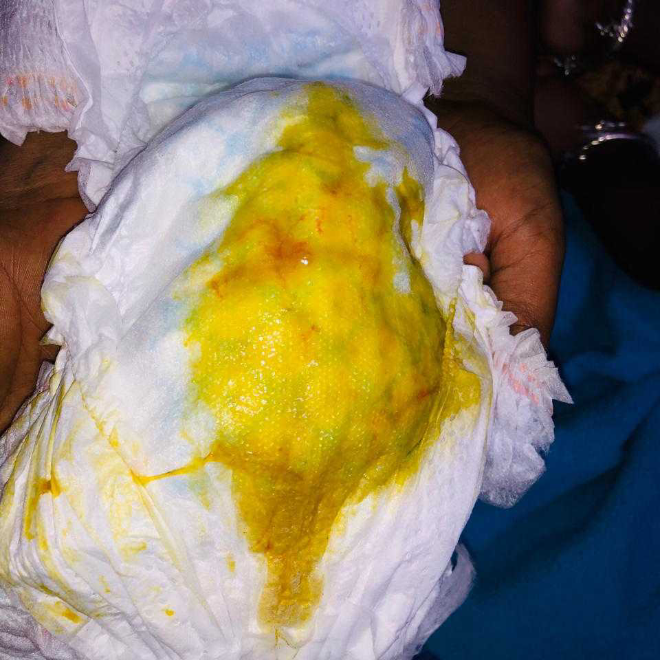 asktheexpert seeing some blood stains in stool FirstCry Parenting