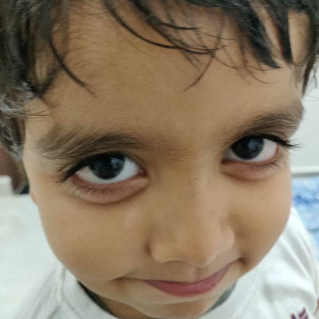 My Kid Have A Little White Spot Single On Face I Noticed When He My Kid Have A Little White Spot Single On Face I Noticed When He