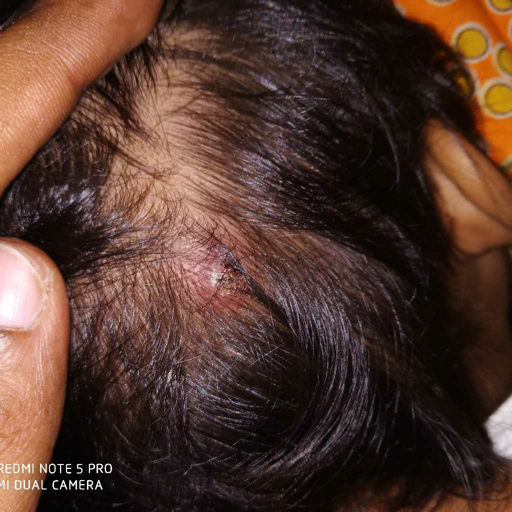 pimples on head medicine