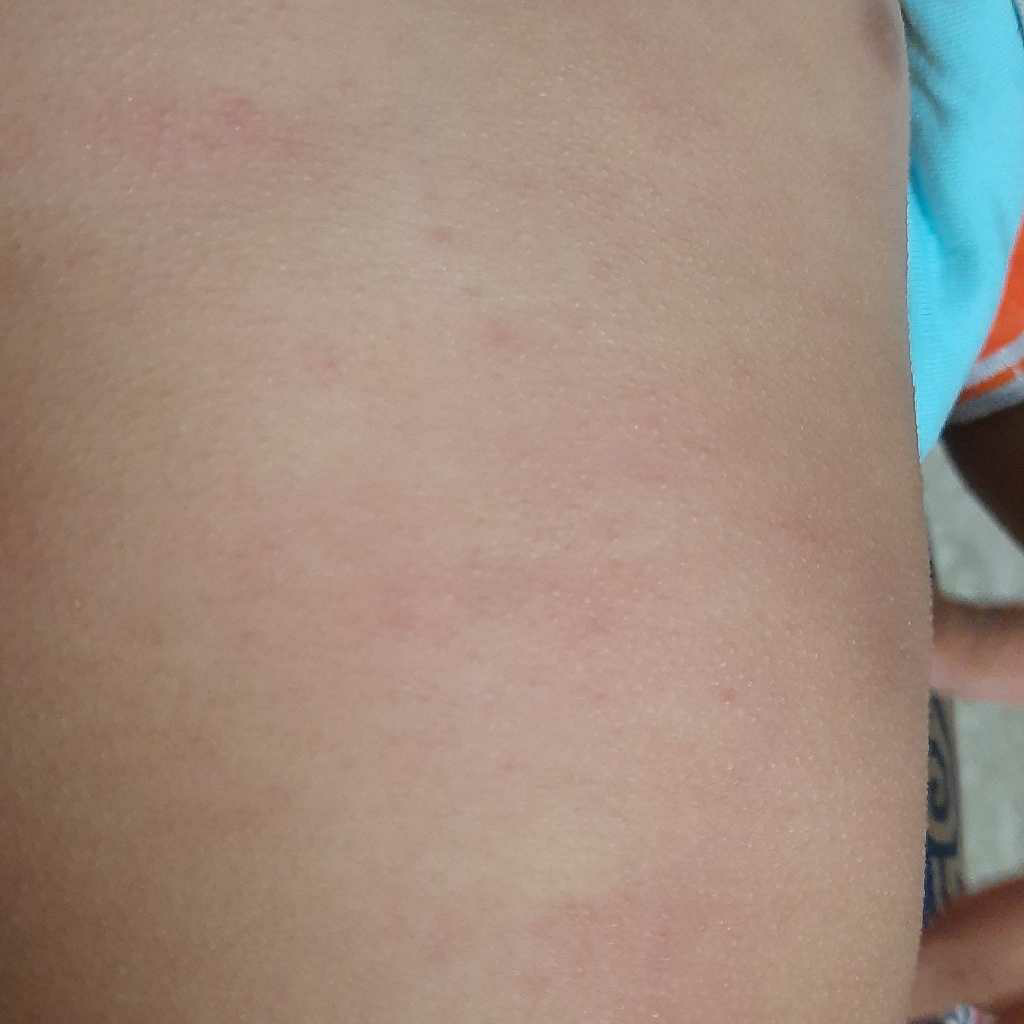 Hlo Doctors My Baby Is 2 Years Oldhe Has Some Rashes Mainly On Chest