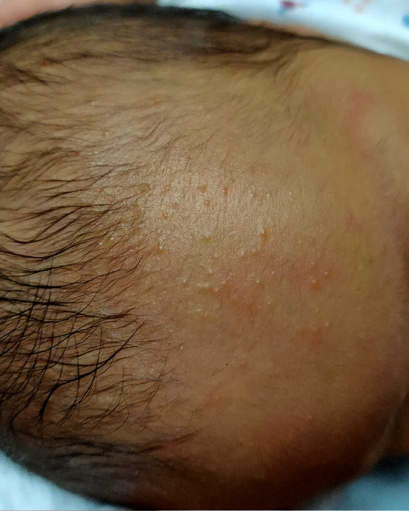 List 91+ Images Rash On Back Of Head After Haircut Latest