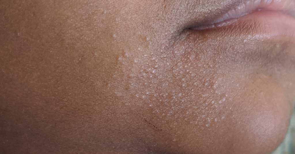 AskDoctors Hello doctor , my baby girl has this type of allergy on her