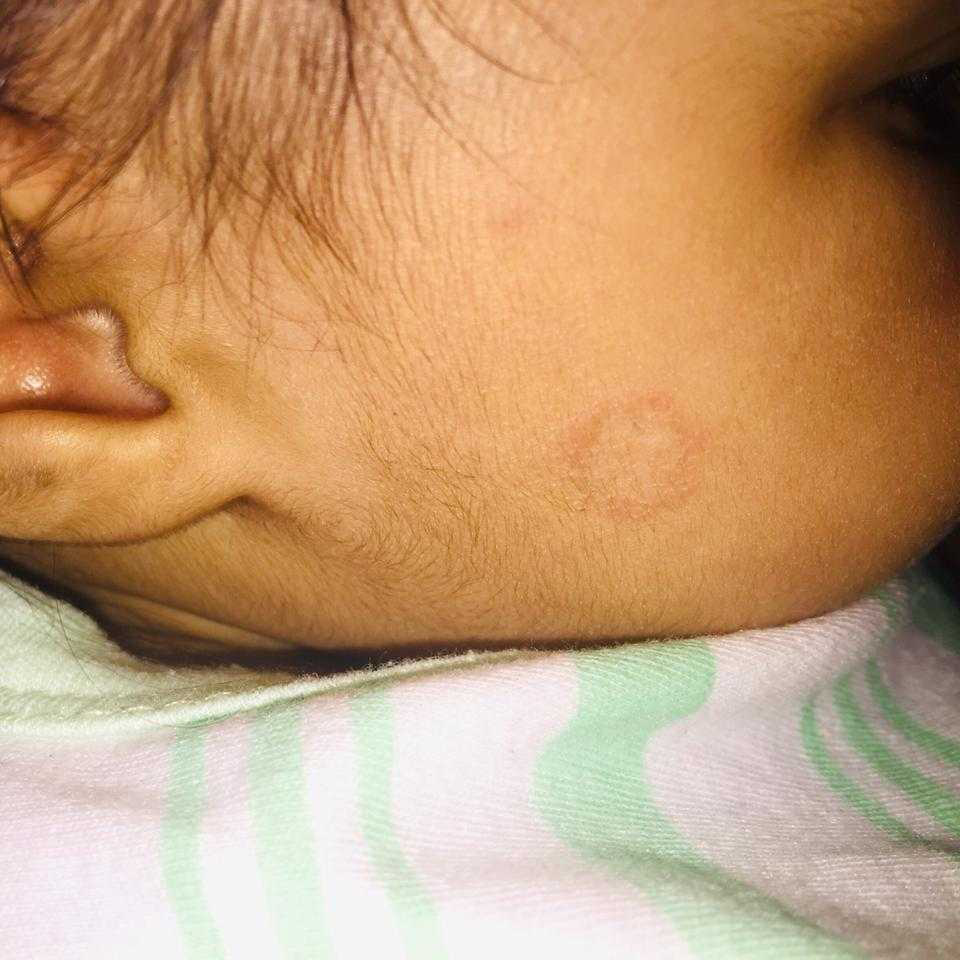 hi. I found a stretch mark/linear scar in the testicle sac of my baby boy who is 17 months old