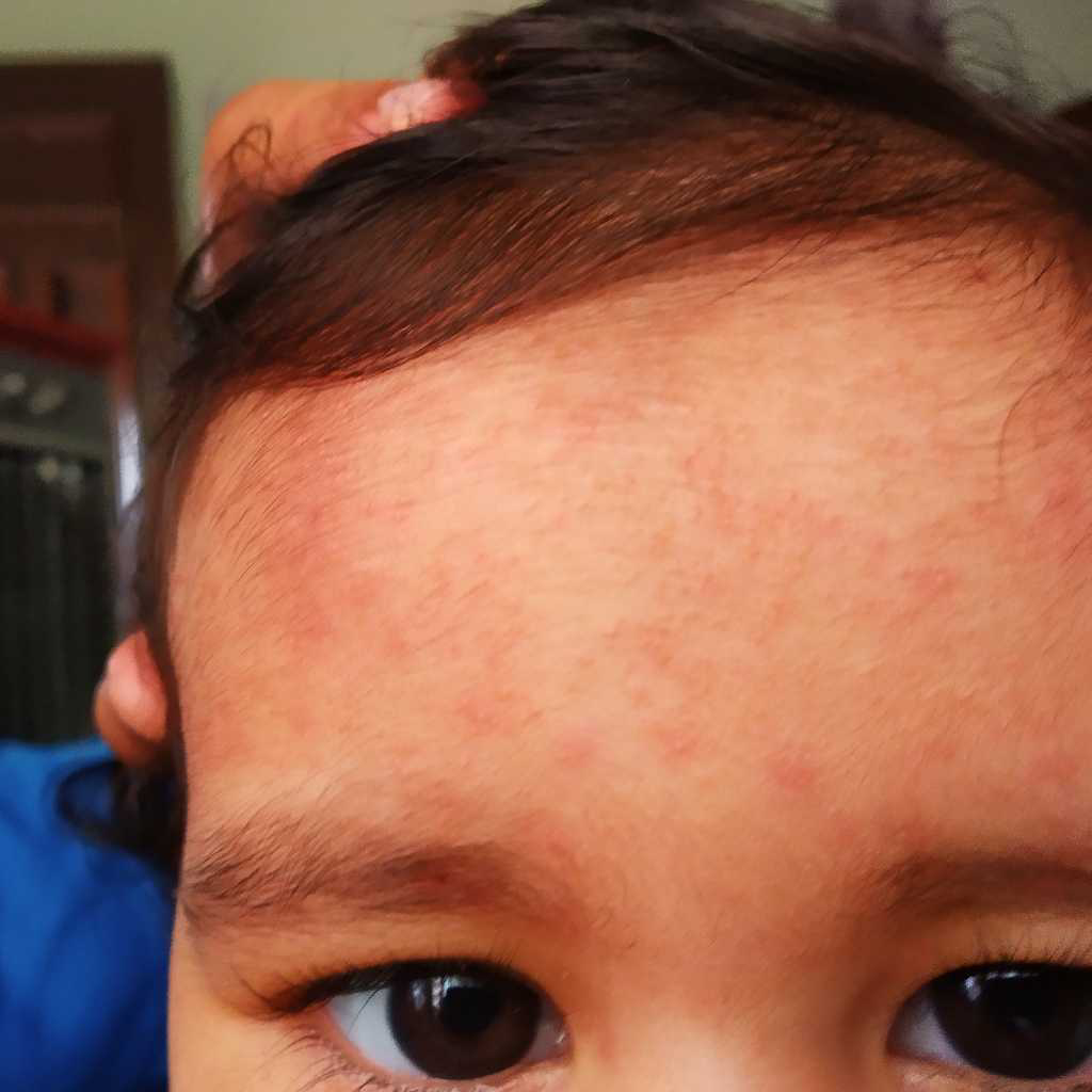 My baby has small red rashes at back side of ear, forehead, lower areas of scalp. He itches alot