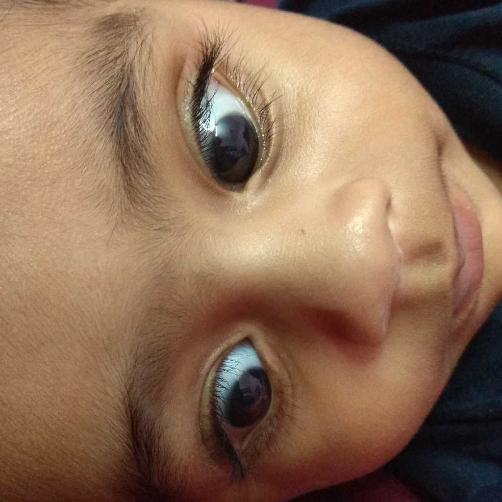 Aggregate 116+ white ring around pupil best netgroup.edu.vn