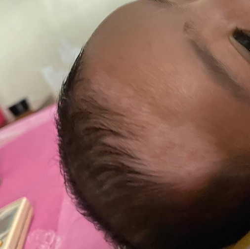 nizoral shampoo for cradle cap