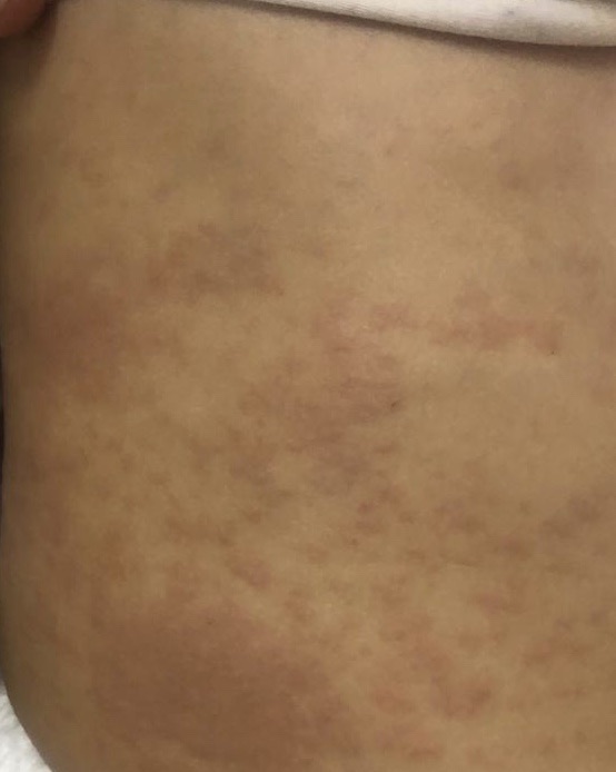 Yuvraj Hv Some Iching Problem Since 2 Months Swelling N Rash Type In His Skin N Iching On Them What S The Actual Proplem After Some Tym The Become Smaller But Iching Is