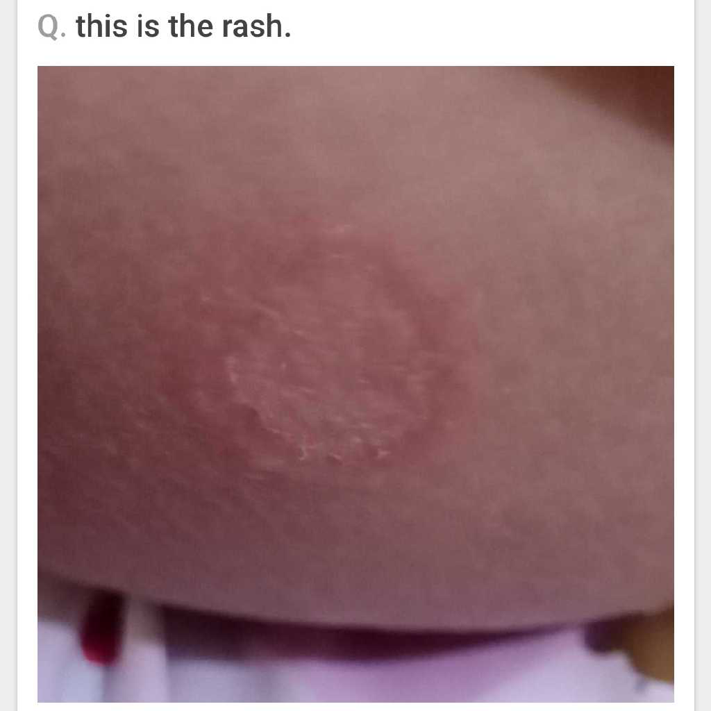 6.5 months old baby has developed Ringworm on his right hand. which