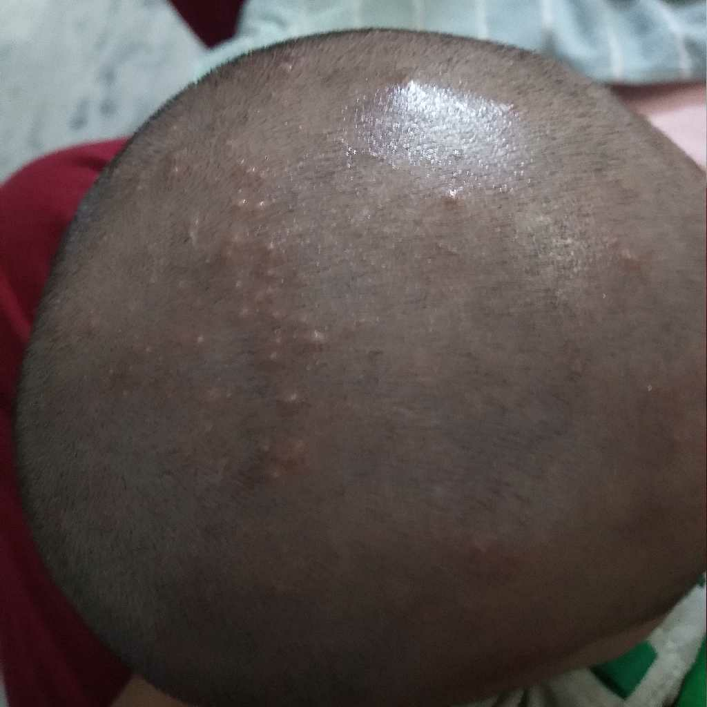 hello..I have a 6m old...she had. these yellowish pimples like on her
