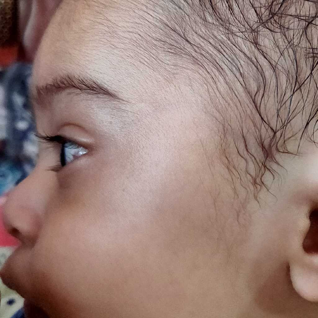 Hi My Baby S Eye Got Red And Some Swelling In White Portion What Hi My Baby S Eye Got Red And Some Swelling In White Portion What