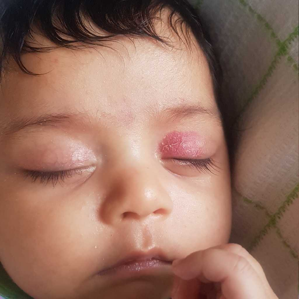 My 2 Month Old Baby Has This Birthmark On Her Left Eyelid Which Itches And Causes Discomfort To Her Is It Permanent How Can The Itchiness Be Cured Firstcry Parenting