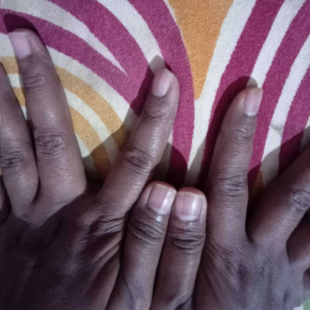 vertical lines on children nails FirstCry Parenting