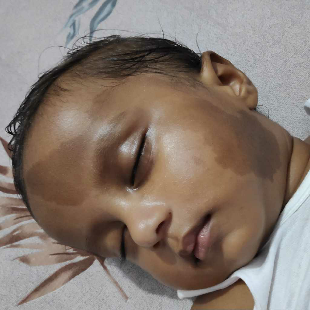 AskTheExpert Hello Dr My child has black marks ( as shown in