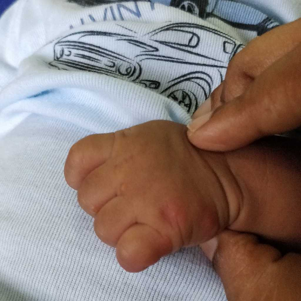 AskTheExpert sir my baby got blisters on hand.. what is the cause