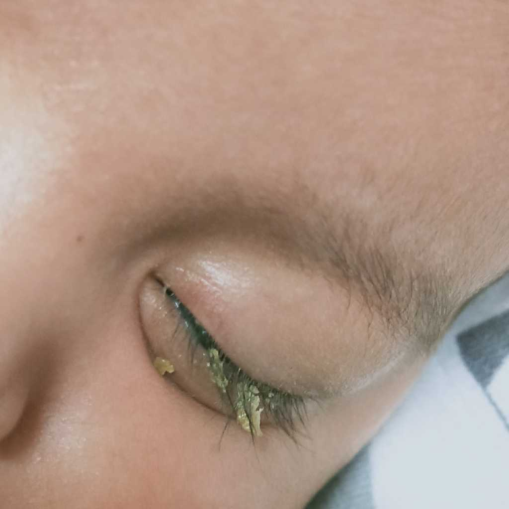 my 3.5 yrs old boy having eye infection and during morning bhis eyes