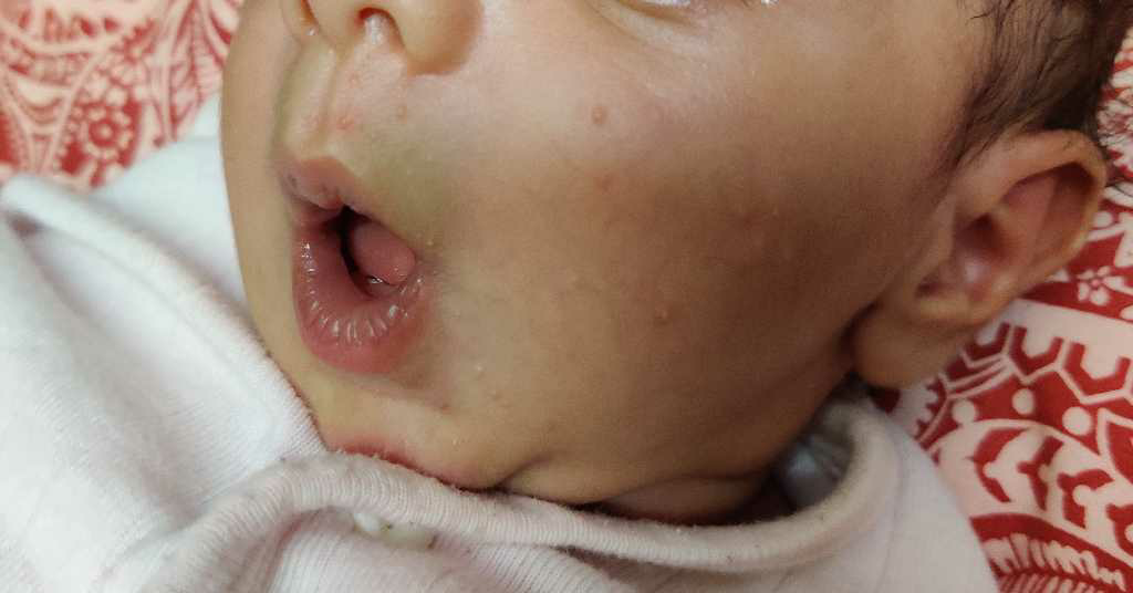 Hello, My two month old son has red daane on his bumps ( picture attached) and the diaper area