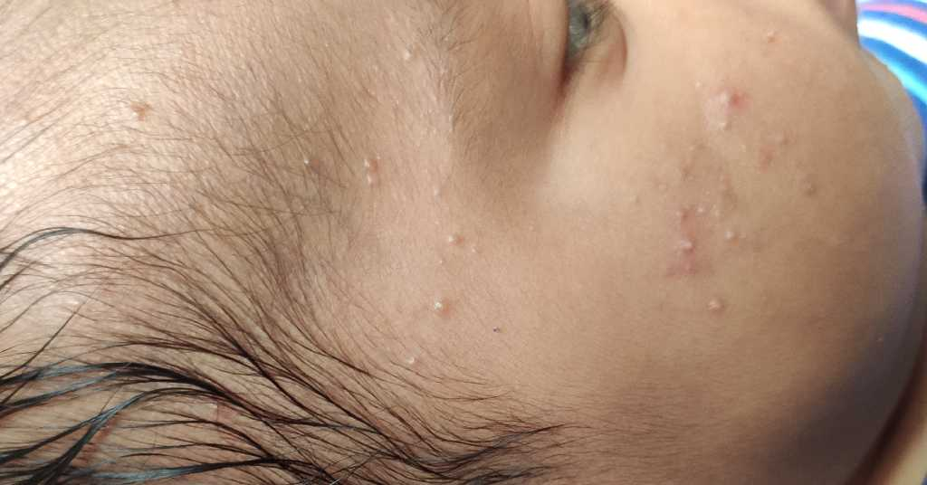 my baby is of 4 1/2 month and is having ringworm kind of thing on his