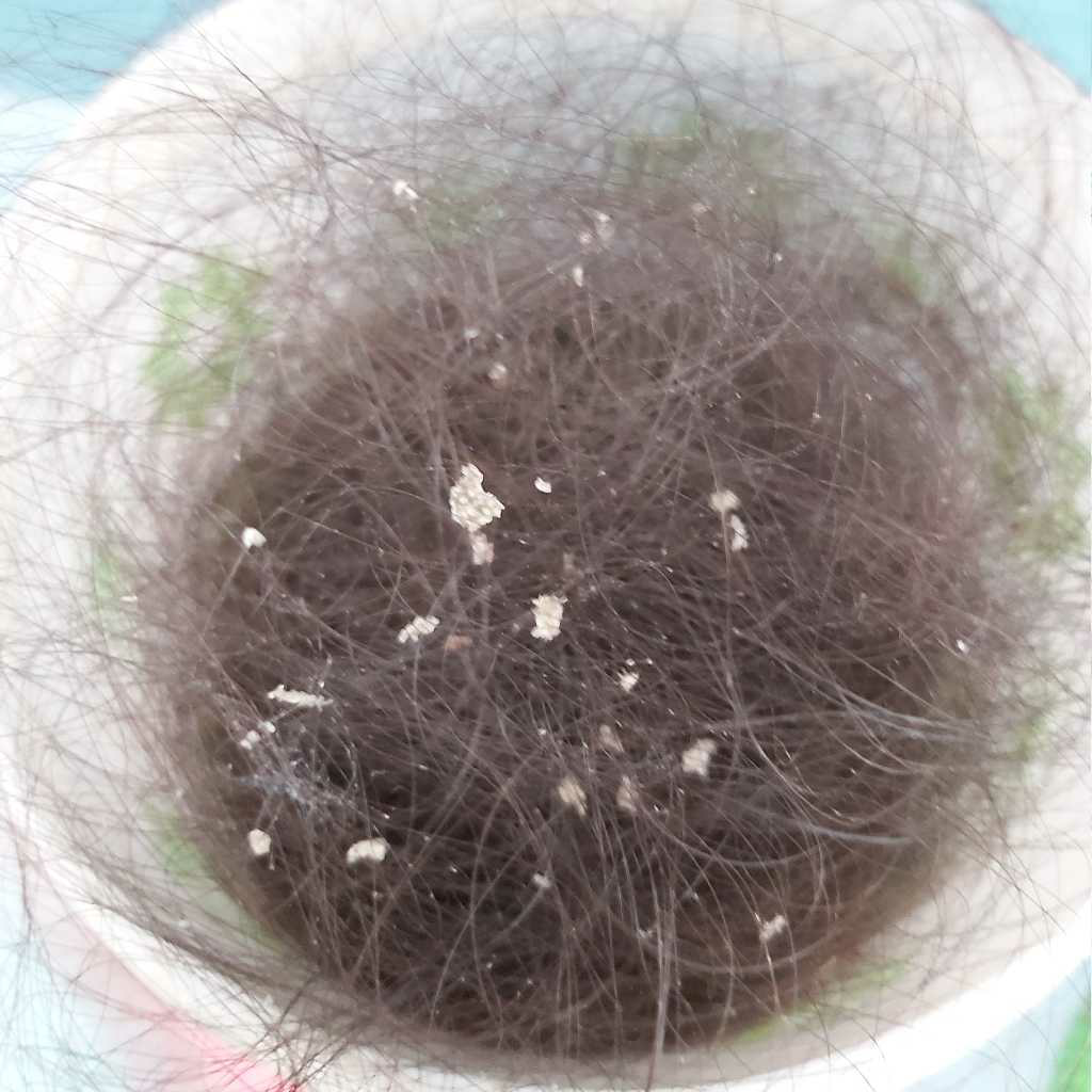 I Have Dry Scalp From My Head So Far I Consult Dermatologist But It Is Not Curing Please Give Any Suggestions To Control It Firstcry Parenting