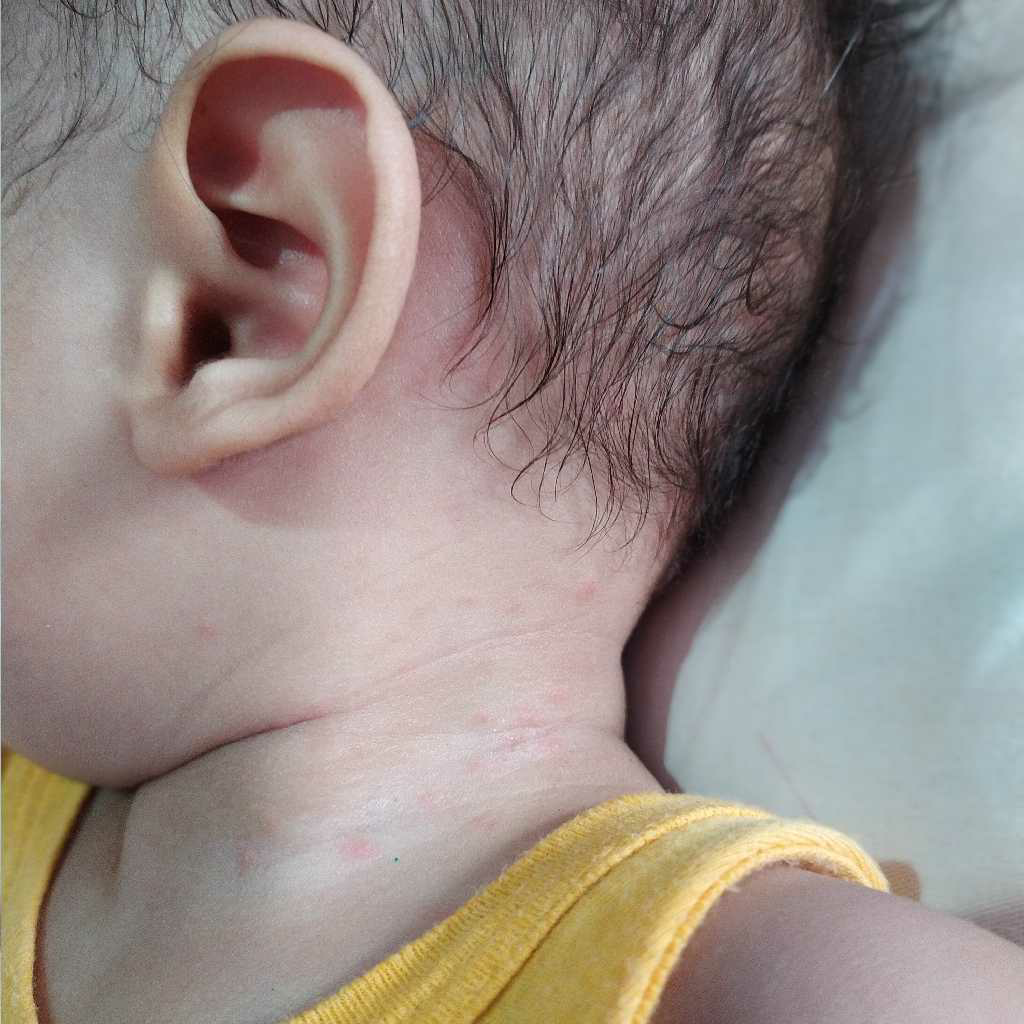 johnson baby oil allergy