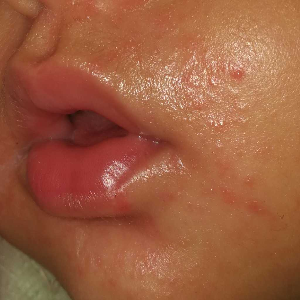 AskTheExpert My Baby Is 6 Months Old I Can See Some Tiny Pimples   1601452682374  1601452661108 