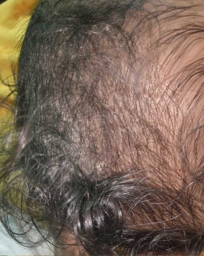 what is this? plz help me. My baby scalp peeling.. FirstCry Parenting