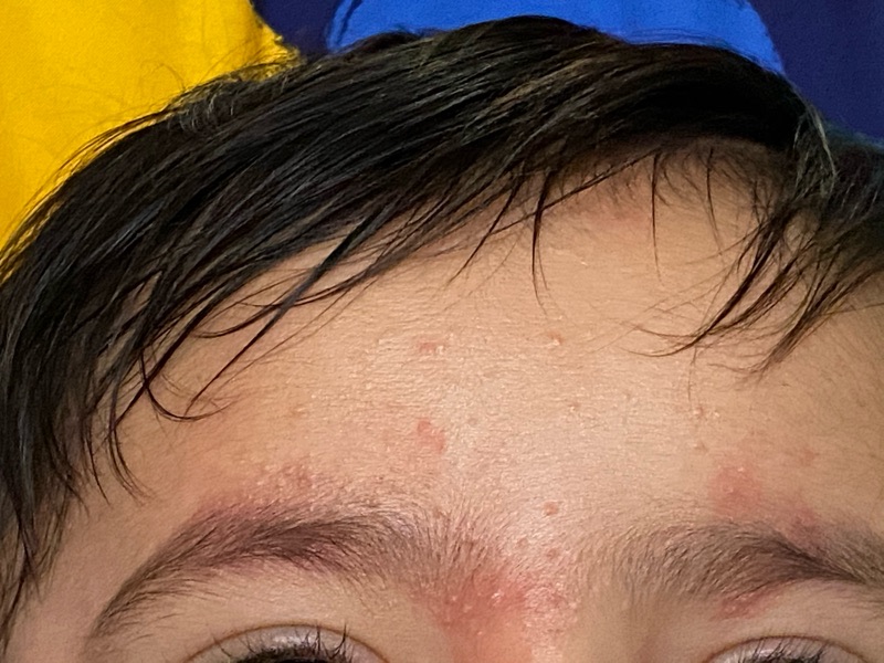 My baby is getting small red pimples on his face and body